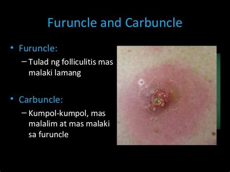 nana sa ulo|Gamot Sa Sugat Na May Nana .